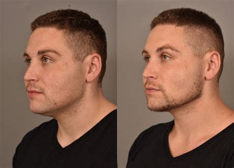 buccal fat removal leeds|Liposuction .